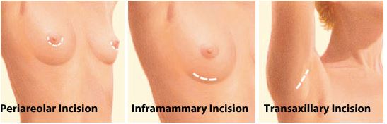 breast-augmentation