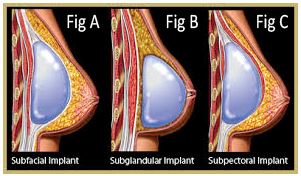 breast-augmentation4
